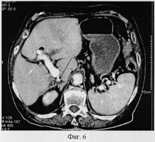 Способ компьютерно-томографической диагностики аномалий развития печени (патент 2297793)