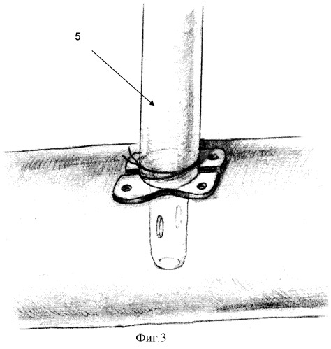 Способ временного артериального сосудистого байпаса при резекции висцеральных ветвей брюшной аорты (патент 2321357)