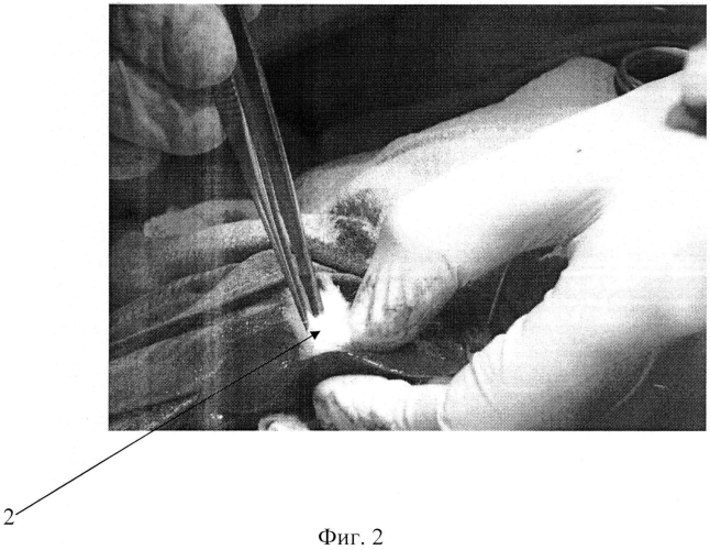 Способ остановки кровотечений при сквозных ранениях печени (патент 2550284)
