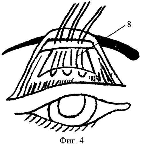 Способ хирургического лечения птоза верхнего века тяжелой степени (патент 2392908)