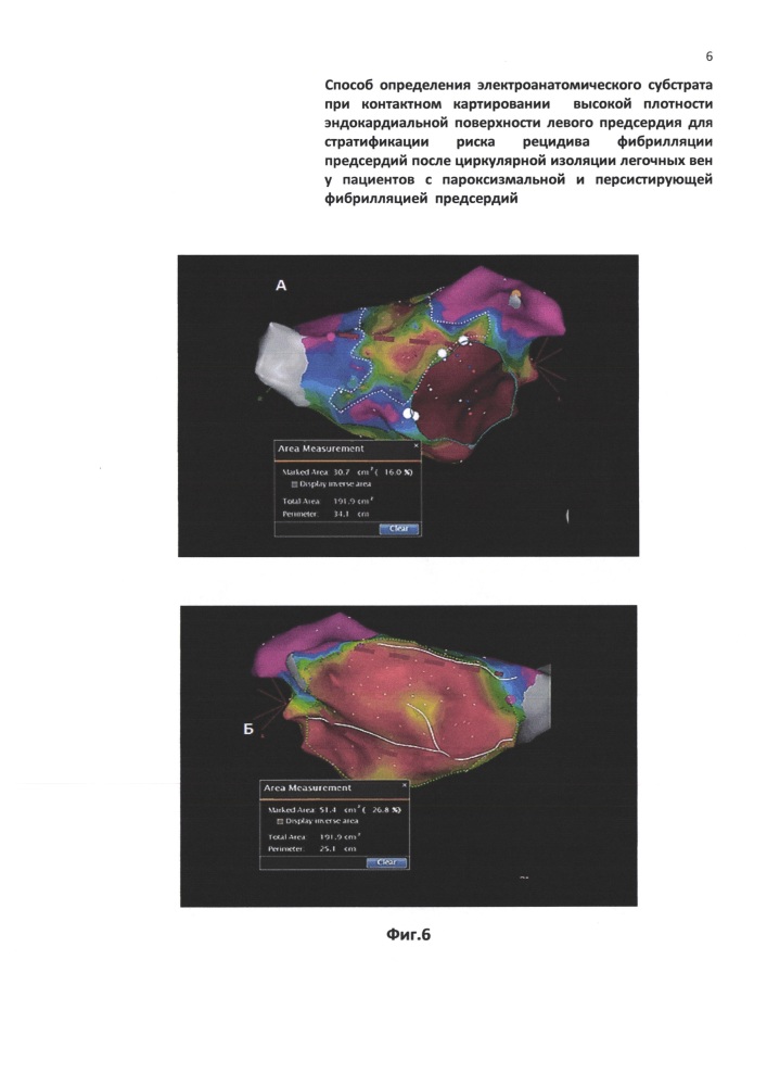 Способ определения электроанатомического субстрата при контактном картировании высокой плотности эндокардиальной поверхности левого предсердия для стратификации риска рецидива фибрилляции предсердий после циркулярной изоляции легочных вен у пациентов с пароксизмальной и персистирующей фибрилляцией предсердий (патент 2649506)