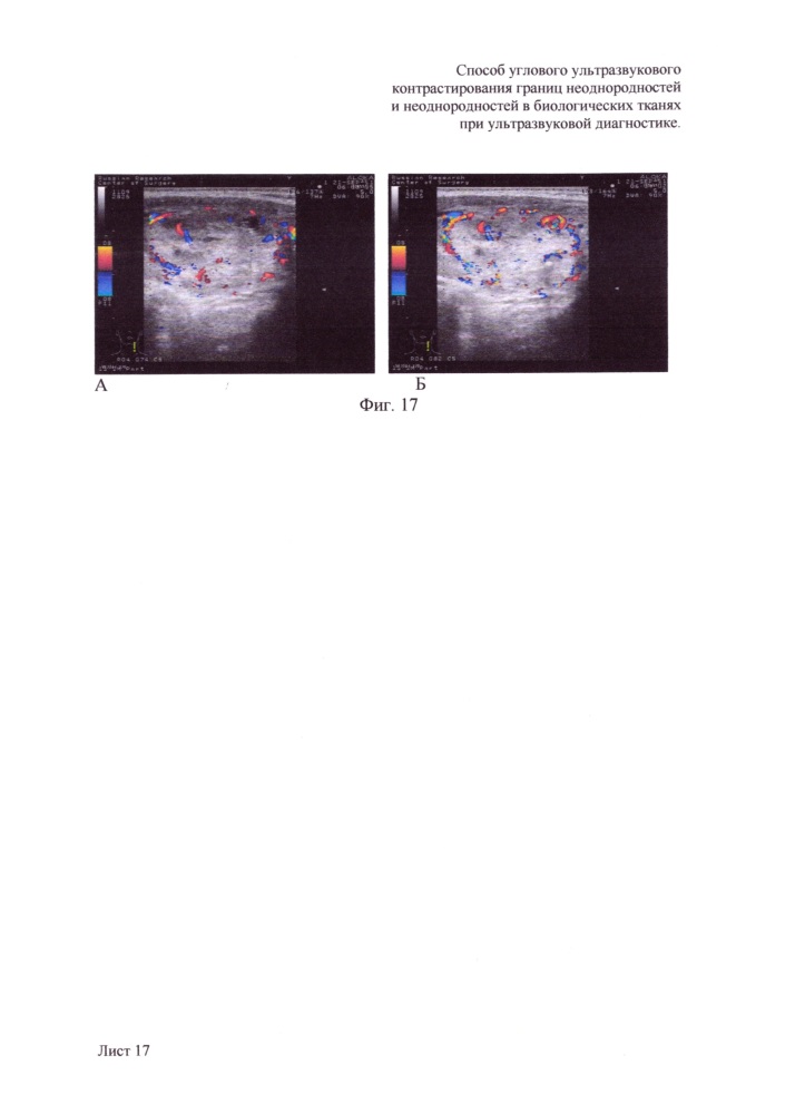 Способ углового ультразвукового контрастирования границ неоднородностей и неоднородностей в биологических тканях при ультразвуковой диагностике (патент 2648880)