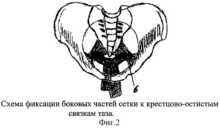 Способ хирургического лечения постгистерэктомического выпадения влагалища на фоне синдрома опущения промежности (патент 2275872)