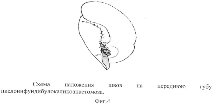 Способ лечения гидронефроза у детей (патент 2495630)