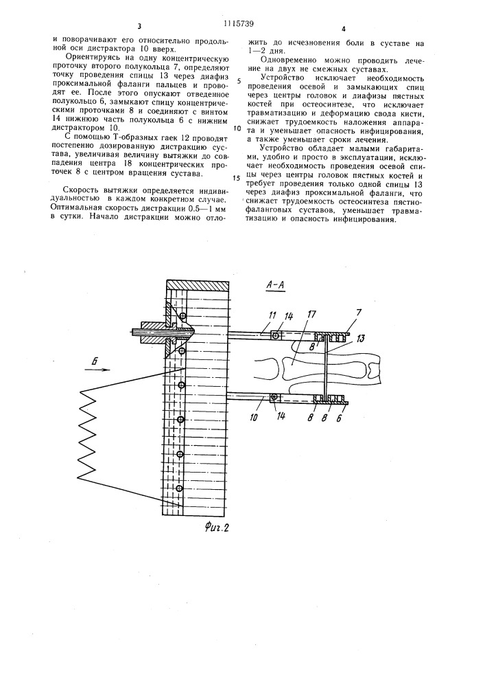 Устройство для лечения контрактур пястнофаланговых суставов (патент 1115739)