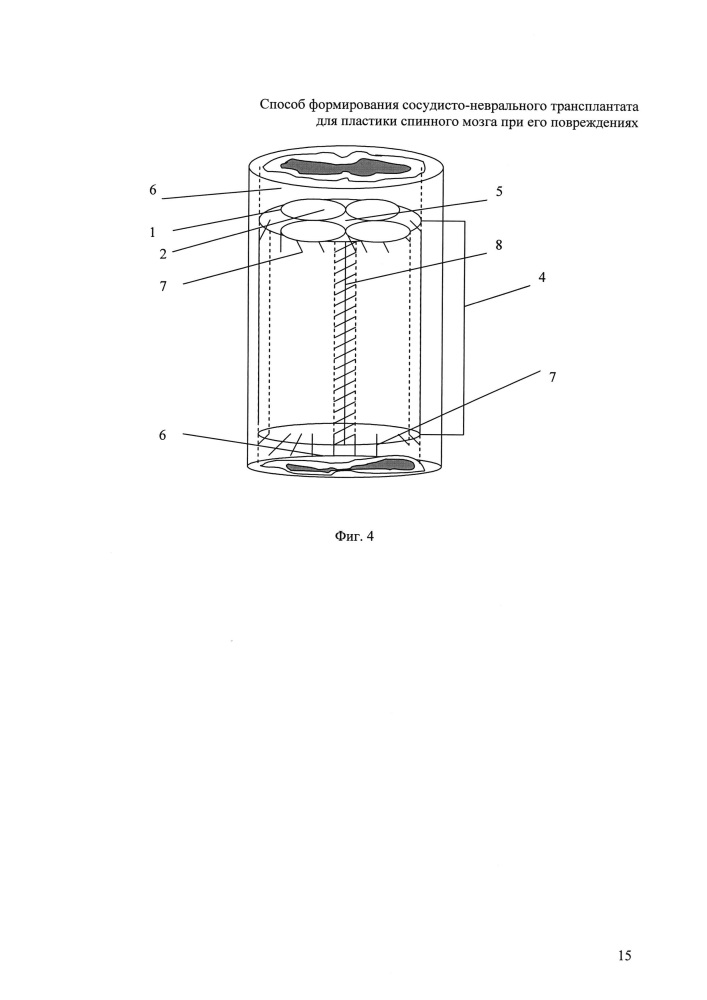 Способ формирования аутовенозно-неврального трансплантата для пластики спинного мозга при его повреждениях (патент 2622634)