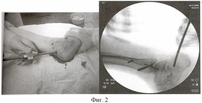 Способ лечения переломов пяточной кости (патент 2440046)