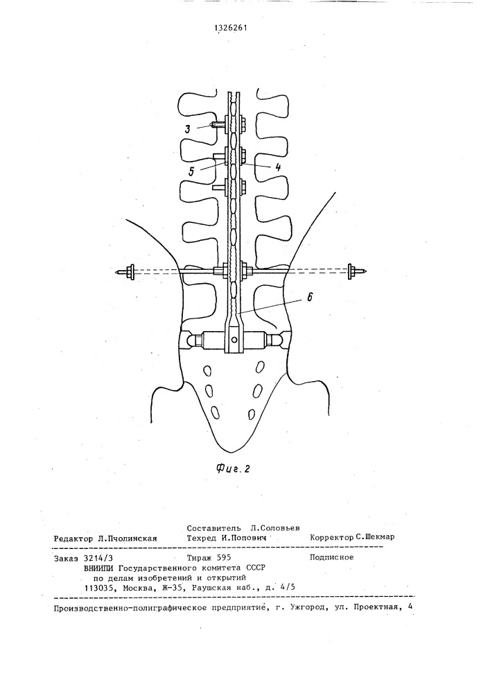 Фиксатор позвоночника (патент 1326261)