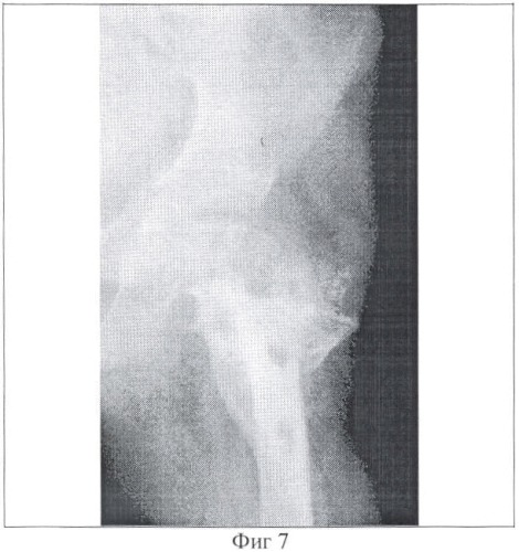 Способ лечения врожденной деформации проксимального отдела бедра (патент 2355337)