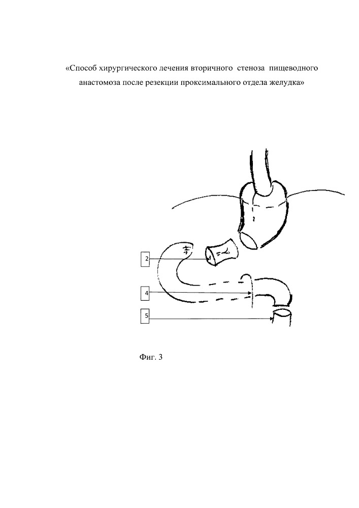 Способ хирургического лечения вторичного стеноза пищеводного анастомоза после резекции проксимального отдела желудка (патент 2657192)