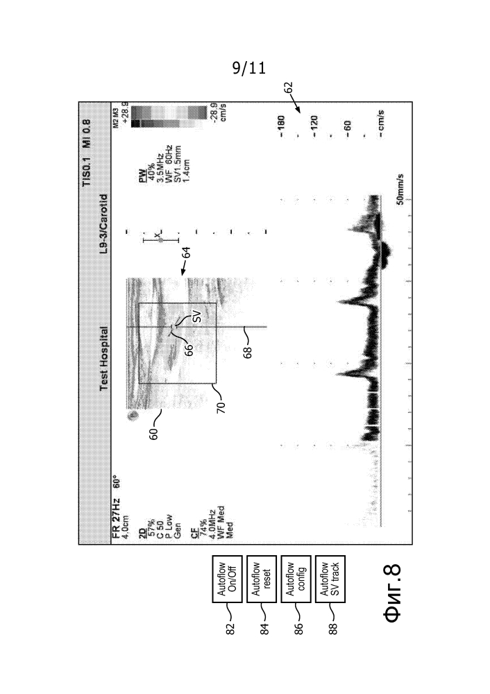 Ультразвуковая система с динамически автоматизированной установкой параметров потоковой допплерографии при движении контрольного объема (патент 2610884)