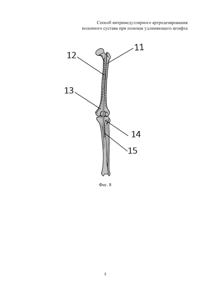 Способ интрамедуллярного артродезирования коленного сустава при помощи удлиняющего штифта (патент 2624674)