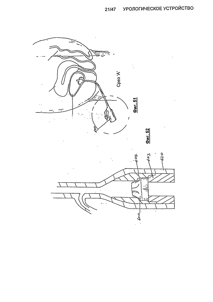 Урологическое устройство (патент 2600865)