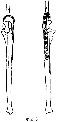 Способ лечения многооскольчатых переломов локтевой кости (патент 2306892)
