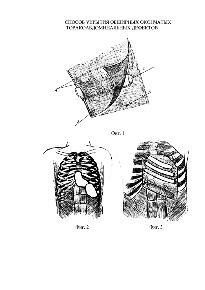 Способ укрытия обширных окончатых торакоабдоминальных дефектов (патент 2600849)