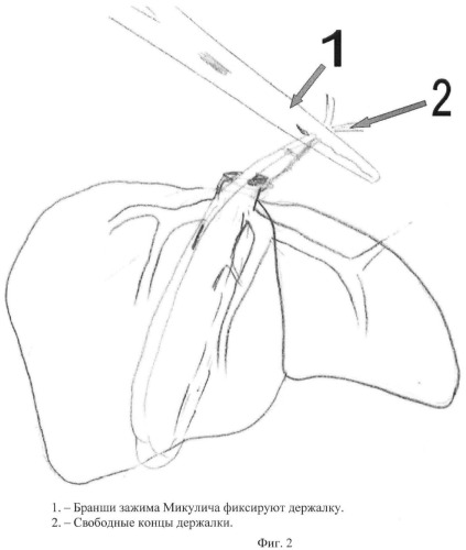 Способ левосторонней гемигепатэктомии (патент 2464941)