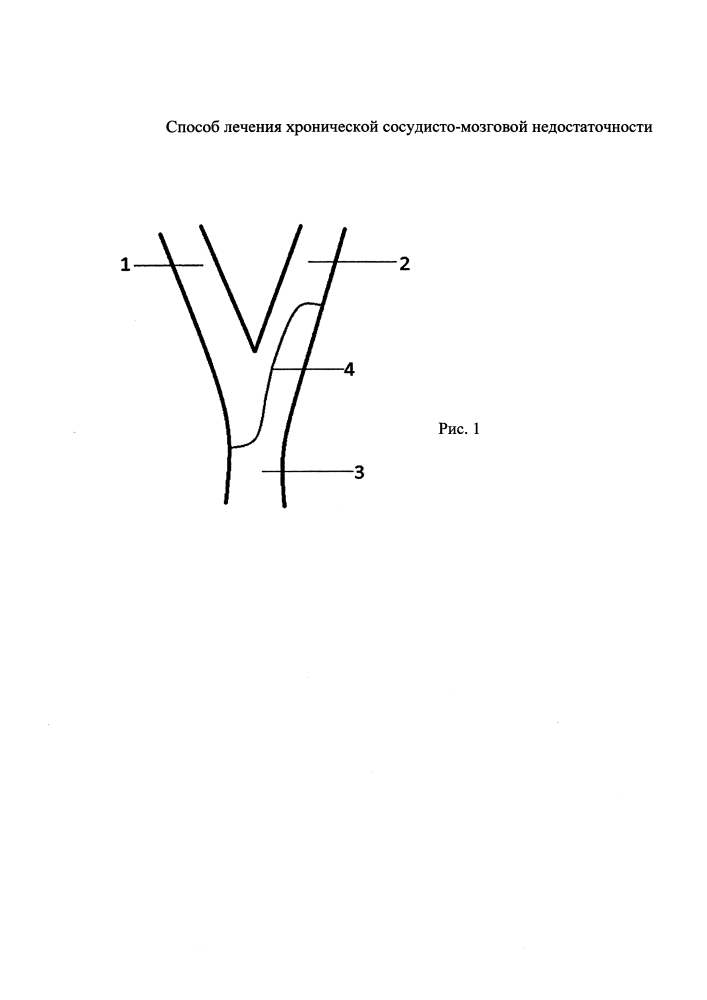 Способ лечения хронической сосудисто-мозговой недостаточности (патент 2635471)