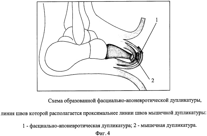 Способ формирования культи стопы (патент 2308244)
