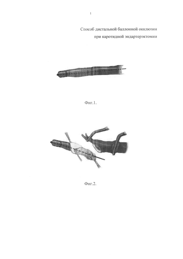 Способ дистальной баллонной окклюзии при каротидной эндартерэктомии (патент 2639802)