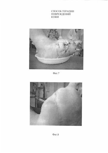 Способ терапии повреждений кожи и биотрансплантат для его осуществления (патент 2588835)