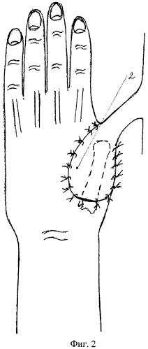 Способ реконструкции пальца при наличии дефекта мягких тканей кисти (патент 2479260)