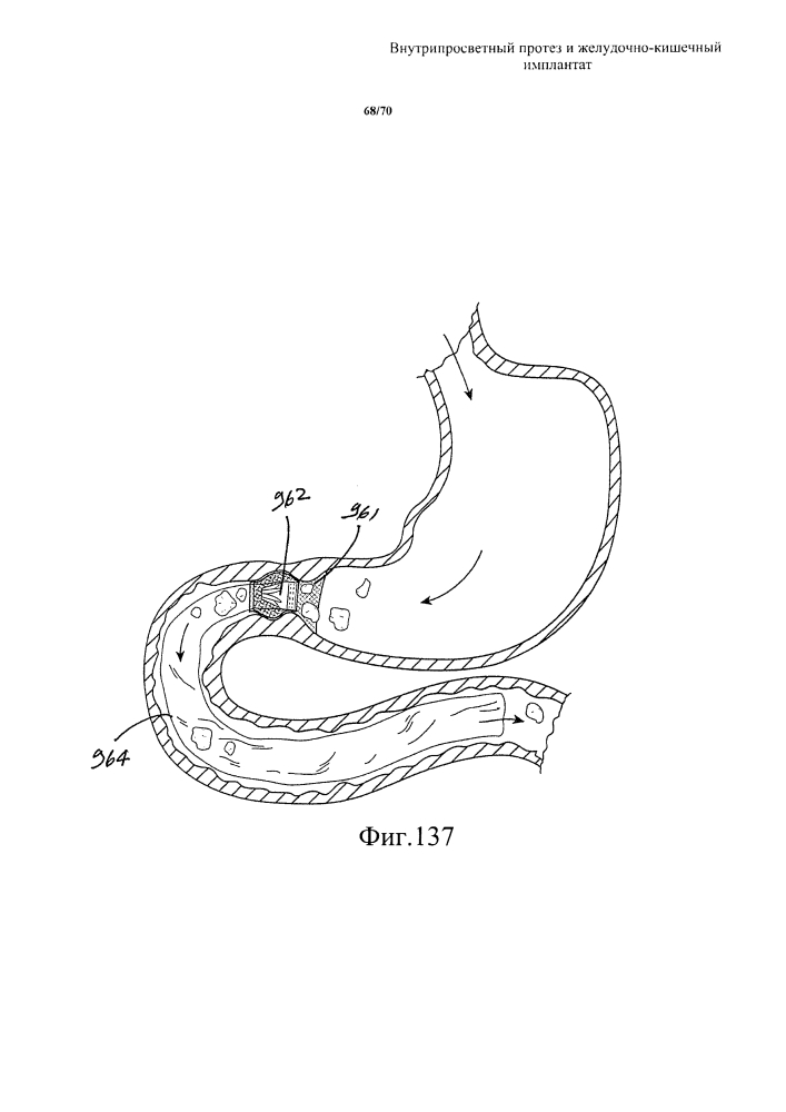 Внутрипросветный протез и желудочно-кишечный имплантат (патент 2626885)