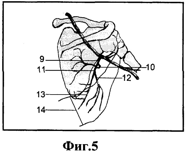 Способ несвободной костной пластики для лечения ложных суставов в верхней трети плечевой кости (патент 2401077)