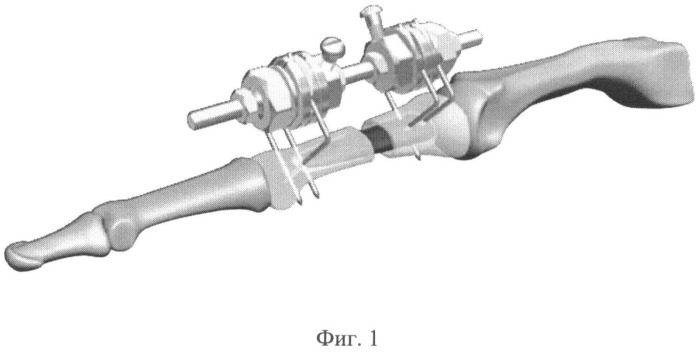 Способ аутокостнопластического замещения пострезекционного дефекта трубчатой кости кисти (патент 2479272)