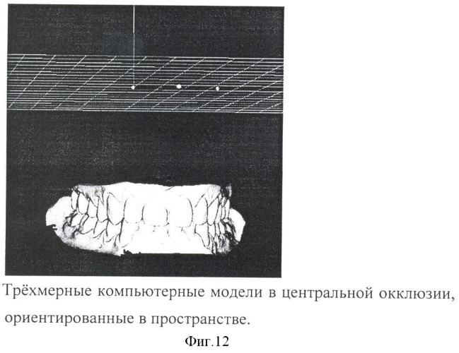 Способ воспроизведения зарегистрированных окклюзионных положений на компьютерных трехмерных моделях зубных рядов и ориентации компьютерных трехмерных моделей в пространстве (патент 2401083)