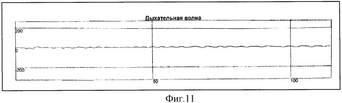 Способ определения типа демпинг-реакции при демпинг-синдроме (патент 2334456)