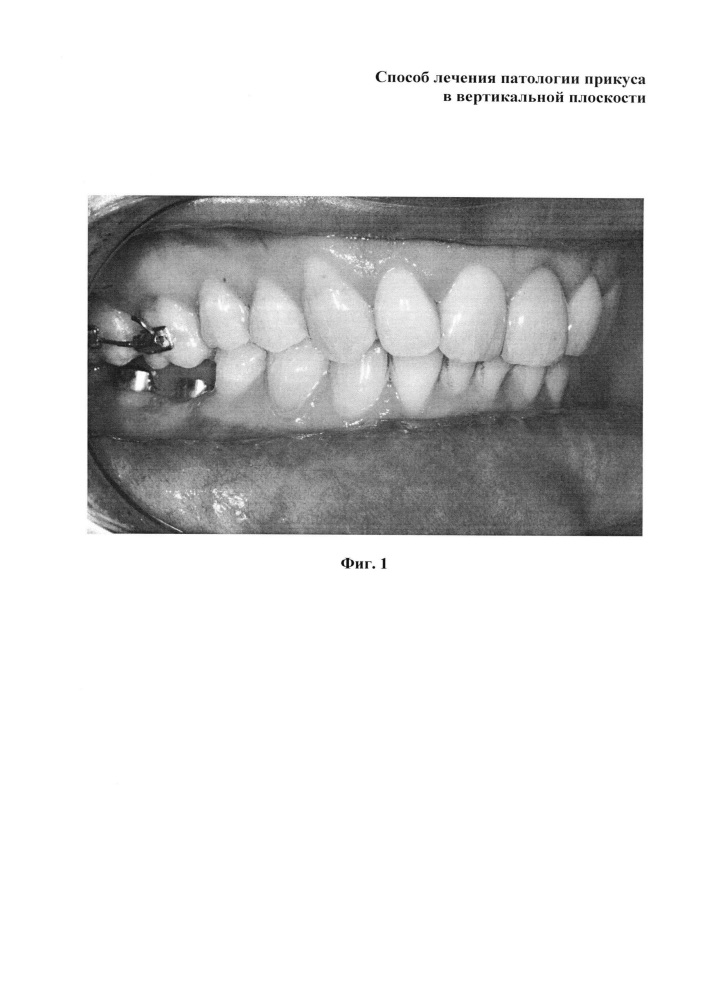 Способ лечения патологии прикуса в вертикальной плоскости (патент 2617181)