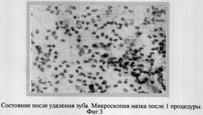 Способ лечения слизистой оболочки лунки после удаления зуба (патент 2304956)