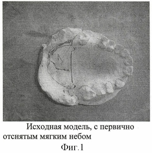 Способ изготовления разборной модели для протезов мягкого неба (патент 2406464)