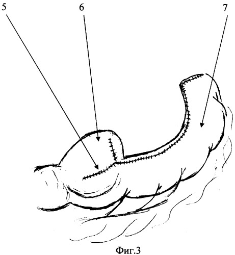 Способ создания желудочной трубки для пластического замещения пищевода (патент 2332173)