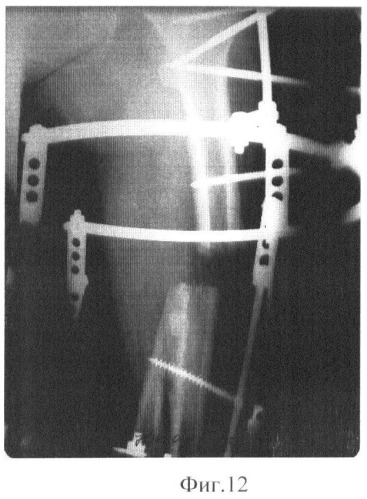 Способ остеосинтеза аппаратом орто-сув для лечения повреждений дистальной трети бедренной кости (патент 2448663)