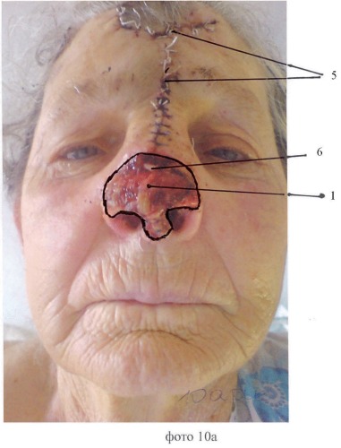 Способ восстановления наружного носа при субтотальных дефектах (патент 2452403)
