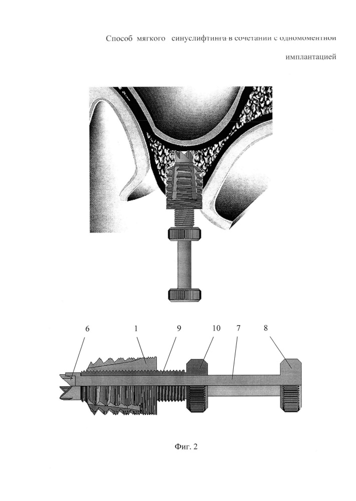 Способ мягкого синуслифтинга в сочетании с одномоментной имплантацией (патент 2651085)