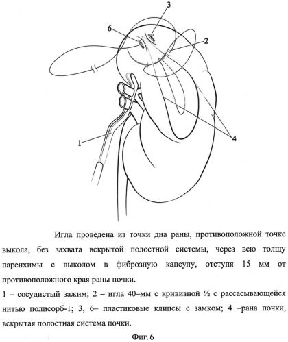 Способ ушивания раны почки при лапароскопическом органосохраняющем лечении рака почки в условиях тепловой ишемии (патент 2532897)