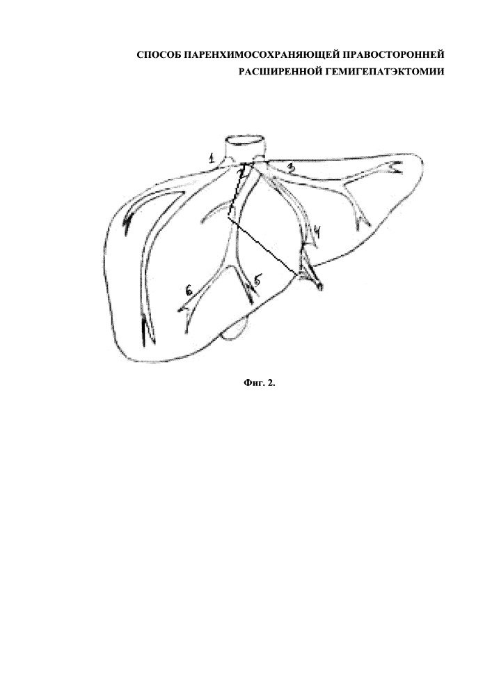 Способ паренхимосохраняющей правосторонней расширенной гемигепатэктомии (патент 2653637)