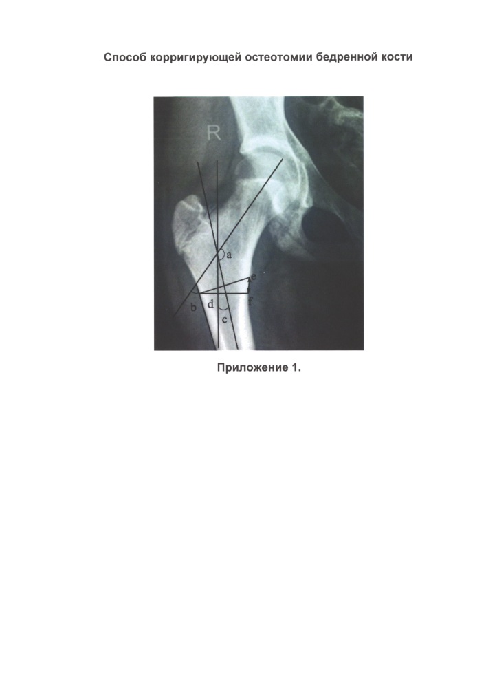Способ корригирующей остеотомии бедренной кости (патент 2656018)
