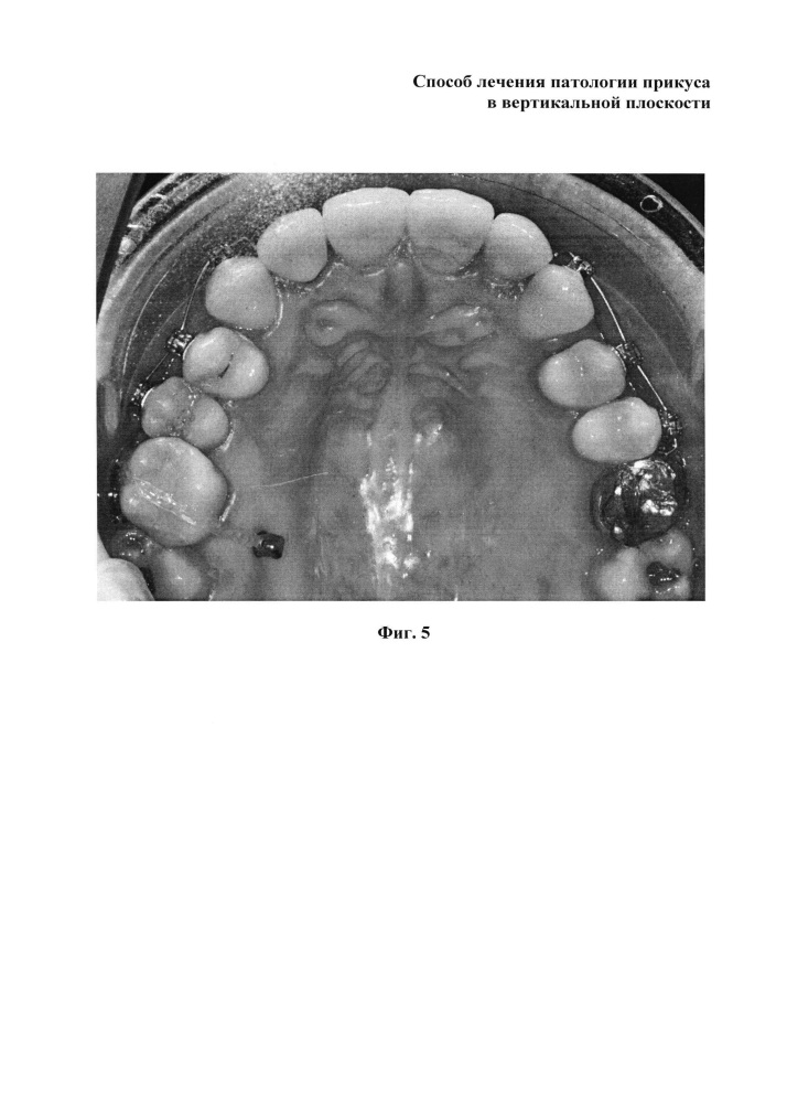 Способ лечения патологии прикуса в вертикальной плоскости (патент 2617181)
