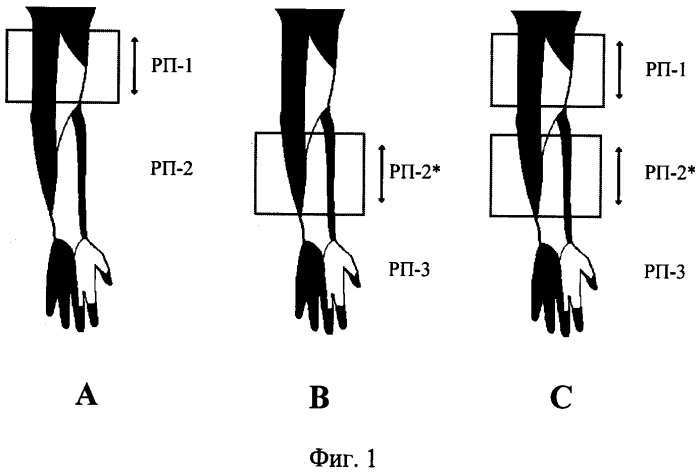 Способ прогнозирования неврологических осложнений в условиях удлинения конечности посредством дистракционного остеосинтеза (патент 2406460)