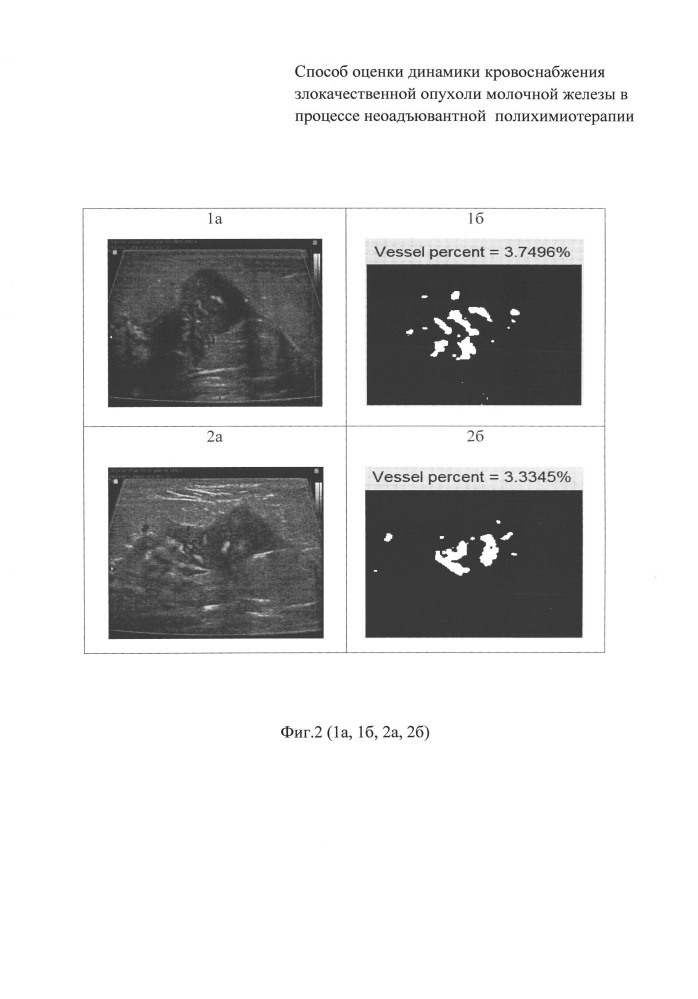 Способ оценки эффективности неоадъювантной полихимиотерапии злокачественной опухоли молочной железы (патент 2641158)