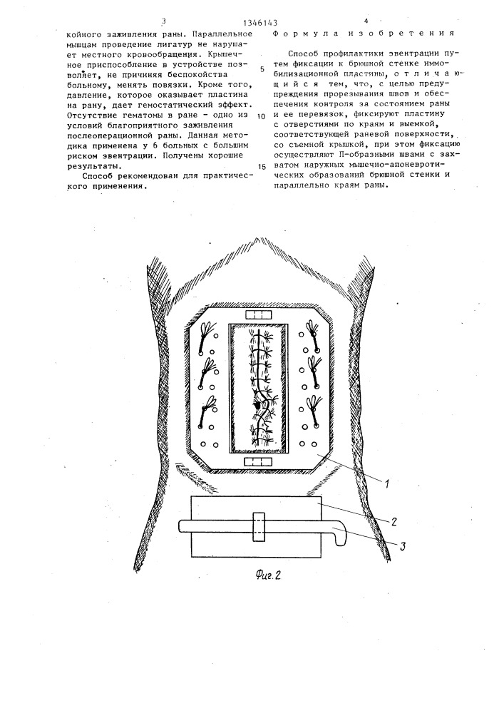 Способ профилактики эвентрации (патент 1346143)