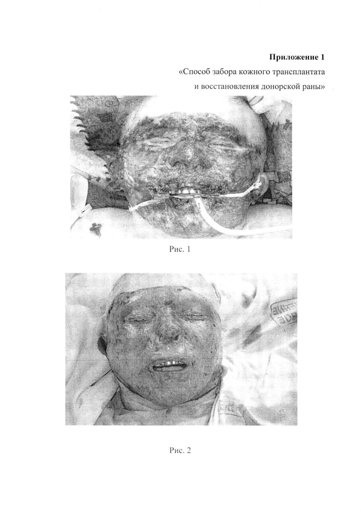 Способ забора кожного трансплантата и восстановления донорской раны (патент 2618907)