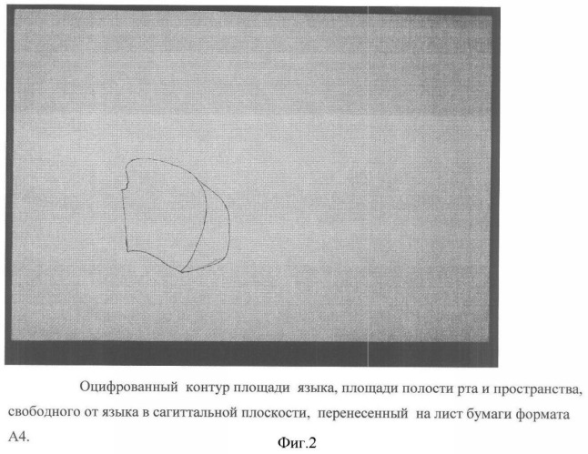 Способ диагностики аномалий зубочелюстной системы (патент 2360604)