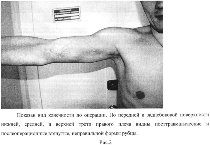 Кодон-оптимизированная рекомбинантная плазмида, способ стимуляции регенерации периферического нерва, способ лечения поврежденного нерва человека (патент 2558294)