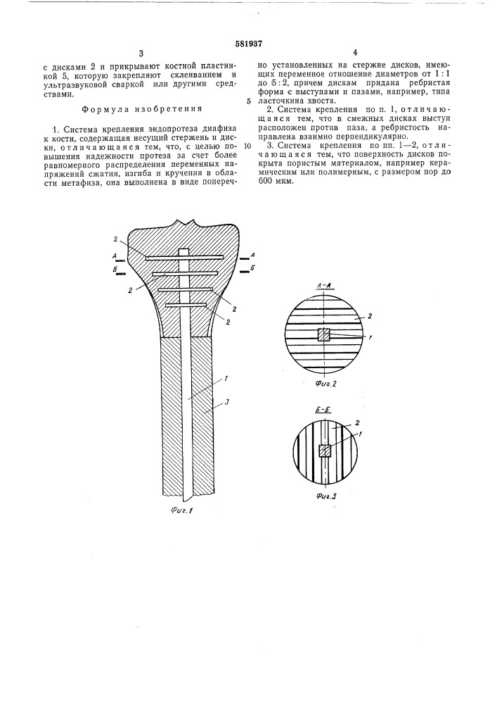 Система крепления эндопротеза диафиза к кости (патент 581937)