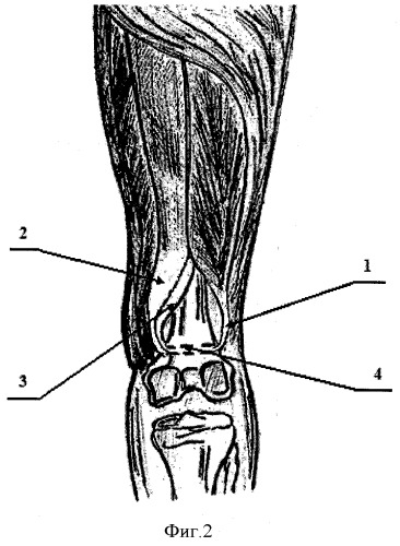 Способ хирургического лечения сгибательной контрактуры коленного сустава при нормопозиции надколенника у больных детским церебральным параличом (патент 2494696)