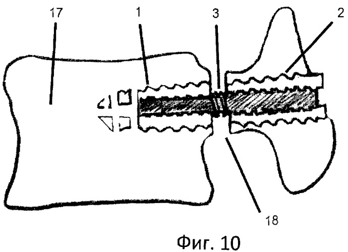 Способ хирургического лечения спинального стеноза поясничного отдела позвоночника и устройство для его осуществления (патент 2462203)